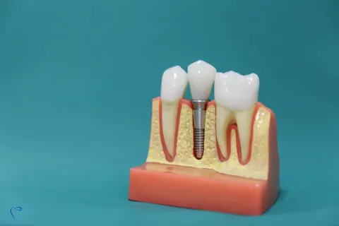 Impianti dentali a Sofia, Bulgaria