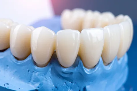 Dental Crowns in Sofia, Bulgaria